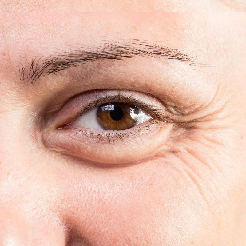 Blefaroplastia 2